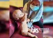 Dua Bayi Penderita Gizi Buruk di Konkep Kondisinya Memperihatinkan